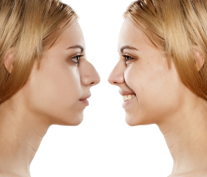 Rhinoplastie avant - après 